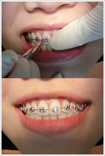 牙齒矯正分期-牙醫