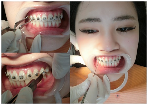 牙齒矯正醫生推薦-牙醫