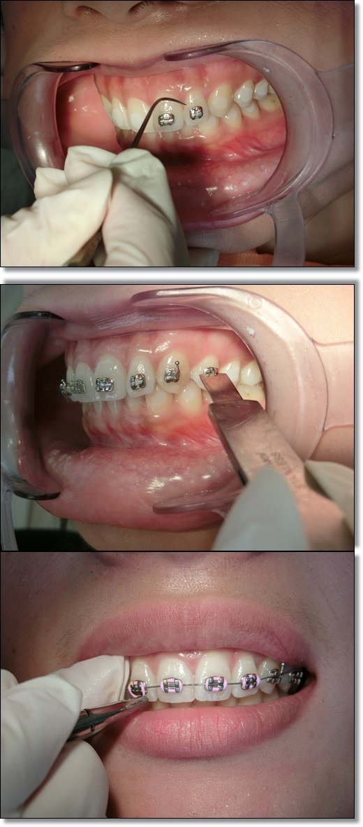 牙齒矯正分期-牙醫