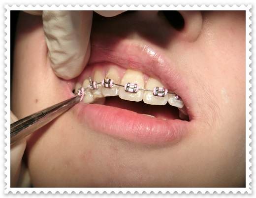 牙齒矯正醫生推薦-