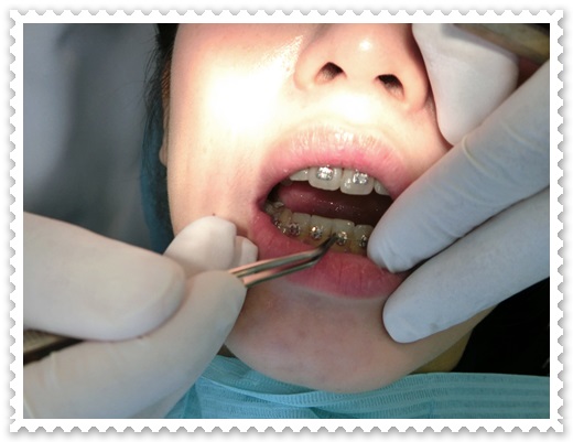 牙齒矯正醫生推薦-
