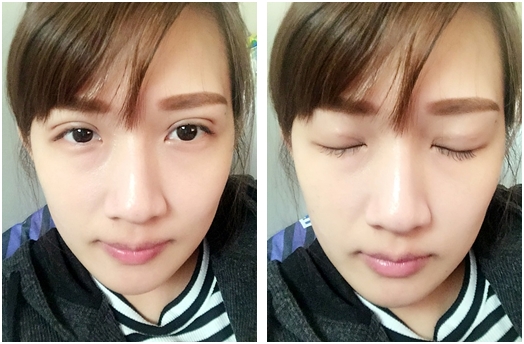[台北半開放雙眼皮] 韓式+開眼頭+訂書針+割雙眼皮+改良+縫雙眼皮+技術+蒙古摺+自然不留疤！